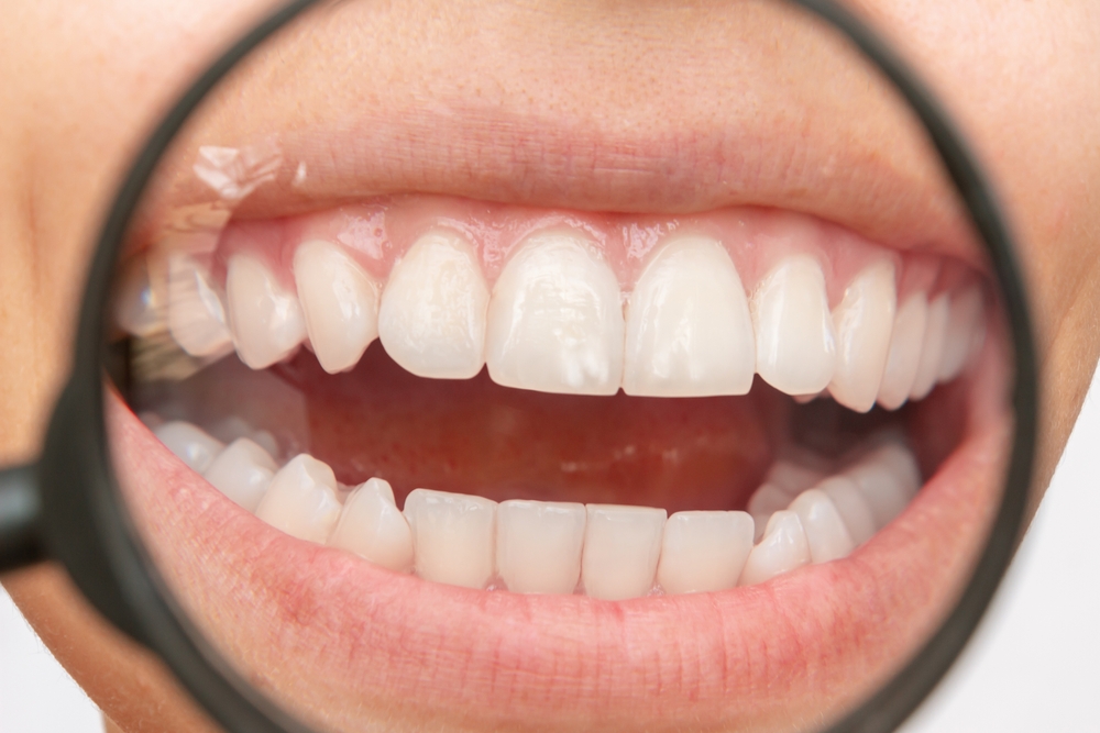 Achieving a Brighter Smile This Spring with Icon White Spot Treatment